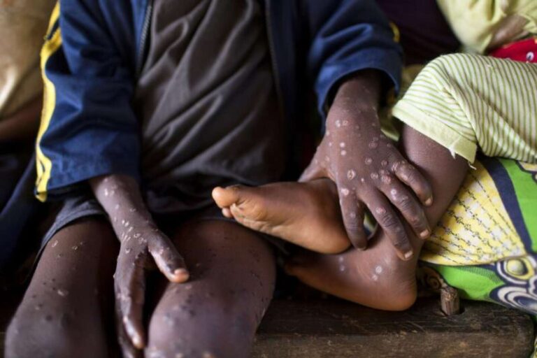 Maladie de la variole du singe (Monkeypox)